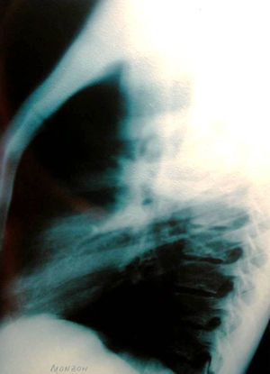 Radiografía de tórax de perfil que muestra una cavidad pulmonar de paredes finas con un nivel líquido.