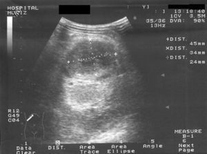 Abdominal ultrasonography scan: hypoecoic lesion (45×34×24mm) in the left kidney, consistent with an abscess.
