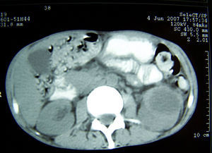 Abdominal computerized tomography scan showing a hypodense image in the left kidney consistent with the renal abscess due to Aspergillus fumigatus.