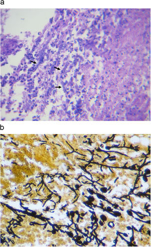 Septate hyaline filamentous forms consistent with Aspergillus spp. (arrows) (a:Hematoxylin–eosin, b:Grocott stain).