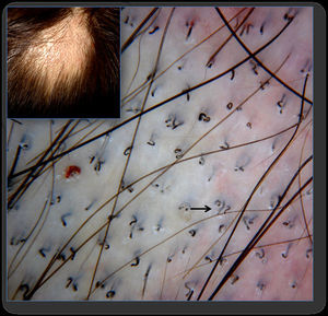 Dermoscopia en tinea capitis con presencia de «pelos en forma de coma» (flecha negra).