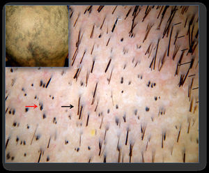 Dermoscopia en alopecia areata con presencia de «pelos en forma de signo de exclamación» (flecha negra) y «pelos cadavéricos» (flecha roja).