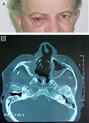 A) Lesión periorbicular derecha. B) En los estudios de imagen se aprecia la lesión que ocupa el seno maxilar derecho con extensión a los tejidos adyacentes. La desestructuración está agravada por la intervención quirúrgica previa.