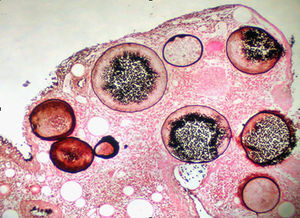 Esporangios de Rhinosporidium seeberi con endosporas coloreadas con Grocott, 40×.