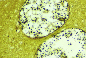 Virchow–Robin spaces showing oval, budding, yeast-like cells surrounded by a capsular material, compatible with Cryptococcus. Grocott–Gomori methenamine-silver stain ×400.