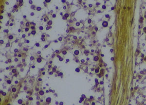 Tissue sections showing the infiltration of the optic chiasm by Cryptococcus. Mucicarmine stain ×400.