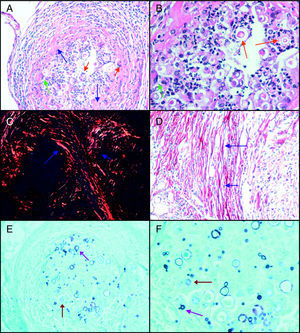 Histological analysis of granulomatous lesions in B10.A mice, susceptible to P. brasiliensis. The organ was collected 15 days after IP infection with the highly virulent Pb18 isolate. This figure illustrates the close interaction of different cell populations with the immune response in the course of experimental infection. A.Compact granulomatous lesion with presence of yeast cells, inflammatory cellular influx and extracellular matrix components. Magnification x200; HE dye. B.Marked influx of phagocytic cells of different lineages, some showing ingested P. brasiliensis cells. Magnification ×400; HE dye. C. Concentric collagen fibers circumscribing the granuloma and eventually containing fungal dissemination. Magnification x200; Sirius red dye observed under Polarized light. D. Marked deposition of thick collagen fibers delimiting the lesion. Magnification x400; Sirius red dye. E. P. brasiliensis at the center of the lesion. Magnification x200; Groccot dye. F. P. brasiliensis with preserved or altered morphology. Magnification x400; Groccot dye. Extracellular matrix components (blue arrows), neutrophils (green arrows), multinuclear giant cells (red arrows), fungi with preserved (violet arrows) or altered (brown arrows) morphology. Figure authors: RFS Molina and E. Burger. Original figure for this manuscript.