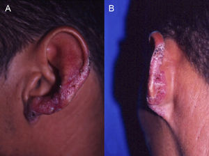 A. Placa atrófica descamativa y ulcerada, de bordes irregulares; en su superficie se observan pequeños puntos negros. B. Extensión de la lesión hacia la región posterior de la oreja.