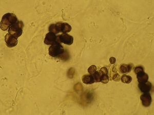 Examen directo en microscopio óptico del raspado de las lesiones con hidróxido de potasio al 10% (x40). Se observan células escleróticas de Medlar.