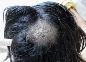 Lesión tonsurante del cuero cabelludo.