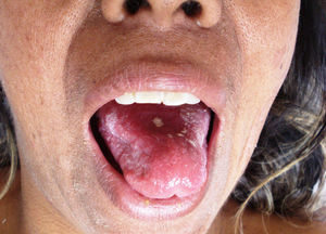 Seudomembranas blanquecinas en la mucosa oral.