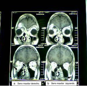 Tomografía axial computarizada en la que se observa: (a) velamiento total del seno maxilar derecho y aire en su interior (flecha); (b) el seno maxilar izquierdo presenta leve engrosamiento mucoso (flecha).