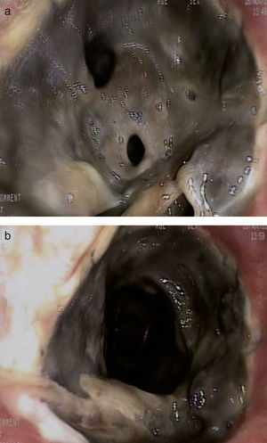 Sutura bronquial tras la limpieza (a). Necrosis de la sutura bronquial derecha con estenosis de más del 50% de la luz bronquial (b).