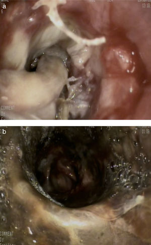 Obstrucción completa del bronquio principal derecho (a). Necrosis bronquial observada tras la limpieza (b).