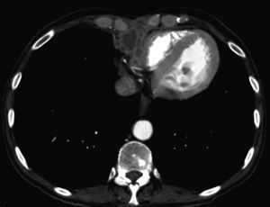 Tomografía computarizada de enero de 2009. Aspergilosis mediastínica. Pe-queña tumoración heterogénea con captación anular del contraste administrado en el ángulo cardiofrénico derecho.