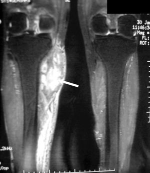 Resonancia magnética: en la pierna derecha se observa una masa de 3 x 7cm compatible con un absceso o flemón en el seno de un proceso inflamatorio celulítico adyacente al gemelo interno y próximo a la cara interna tibial a nivel metafisario.