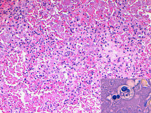 Examen histopatológico del pulmón con hematoxilina-eosina donde se observan formaciones granulomatosas (×20). En detalle, con la tinción de PAS-diastasa, se observa Histoplasma capsulatum en el interior de los macrófagos (×63).