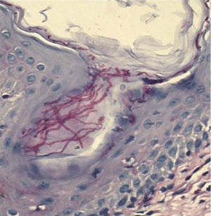 Biopsia de piel: numerosas hifas. Tinción PAS (40×).