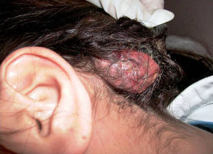Lesión nodular de cuero cabelludo, con áreas de supuración y ulceradas.