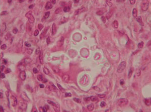 Microfotografía del examen histopatológico de la biopsia pulmonar. Tinción de hematoxilina-eosina, 400×.