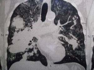 Tomografía computarizada de tórax antes del tratamiento. Se observan infiltrados densos y difusos, bilaterales, imágenes cavitarias y nodulares.