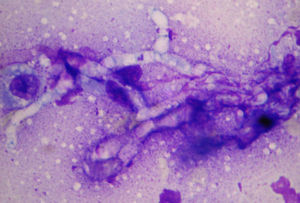 Presence of thick-walled hyphae, sparsely septate, irregularly branched at a right angle, 1000×.