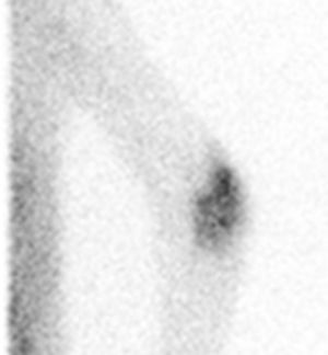 Rastreo isotópico con galio 67 que muestra la existencia de un depósito patológico en la articulación del codo izquierdo.