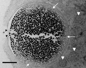 Electron microscopy tissue section showing a Rhinosporidium seeberi mature sporangium containing hundreds of endoconidia, one already outside the sporangium and the others in the process of being expelled through a pore (arrow heads) (a video depicting the endoconidia release is available at: http://www.bld.msu.edu/Rhino). Note the presence of a thin cell wall and the formation of three prominent inner layers (a clear space between the mature endoconidia and the cell wall) primarily located near the pore. At this magnification this structure appears as a single inner layer, but it comprises three well defined inner layers.40 The presence of fully developed endoconidia is observed at the center and toward the pore, whereas immature small usually oval endoconidia are found at the opposite site (white heads), a distinctive feature of mature sporangia. Three immature sporangia are also noted in the lower section of the mature sporangium (white arrow heads) (Bar=100(μm).