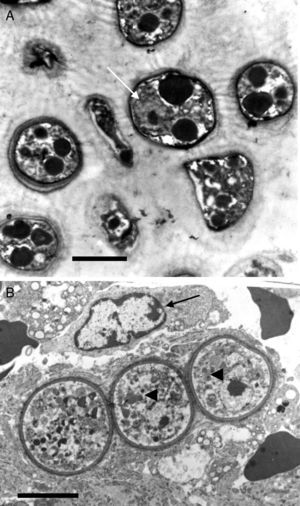 This electron micrograph shows several Rhinosporidium seeberi's purified endoconidia, one of them containing a nucleus with a prominent nucleolus (arrow) (Panel A). The endoconidia are characterized by a thin cell wall, numerous electron dense bodies (EDBs, dark vesicles), and the presence of a granular mucilaginous capsule (Bar=5(μm). Panel B shows three early juvenile sporangia (JS) within the host infected tissues, before the first nuclear division (Bar=15(μm). The presence of nuclei with prominent nucleolus is observed in two of the JS (arrow heads), which contrast with the nucleus displayed by the host's inflammatory cells (arrow). The JS on the left lacks nucleus because it was sectioned in a segment of the cell where the nucleus was not near. The presence of prominent cell wall and several vesicles typical of this stage is also noted.