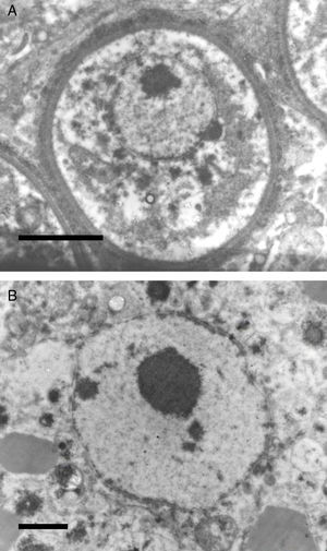 The electromicrograph in panel A shows an enlargement of a juvenile sporangium with a typical nucleus and a prominent nucleolus (Bar=8.0(μm). Note the nuclear membrane surrounding R. seeberi's chromatin. Details of the nuclear membrane and the nucleolus can be observed in panel B (Bar=2.0(μm). In this EM close up the presence of several vesicles is also observed around the nucleus. Panels A and B and Figs. 2 and 3 (this review) give details on the typical morphological features of R. seeberi nuclei and establish without doubt that R. seeberi is a true eukaryote microbe.