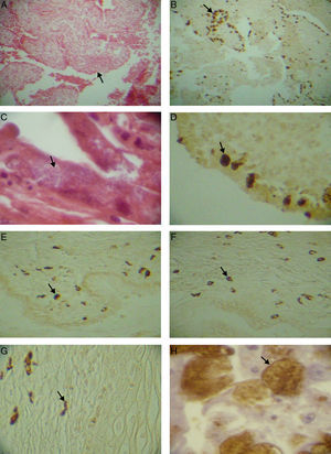 (A) Low magnification microphotograph of the fallopian tube mucosa with thickened plicae (arrow), H/E 6×. (B) Immunodetection of E. cuniculi in the fallopian tube mucosa (arrow), IHQ 6×. (C) Microsporidial parasitophorous vacuoles in fallopian tube mucosa (arrow), H/E 40×. (D) E. hellem parasitophorous vacuoles in the superficial epithelial layer of endometrium (arrow), IHQ 20×. (E) and (F) E. cuniculi parasitophorous vacuoles within macrophages located in the cervix stroma underneath the columnar epithelium (arrow), IHQ 20×. (G) E. cuniculi parasitophorous vacuoles in the exocervix stroma underneath the squamous epithelium (arrow), IHQ 20×. (H) High resolution under oil photomicrograph showing E. hellem parasitophorous vacuoles (arrow), IHQ 100×.