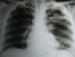 Radiografía de tórax de frente. Se observa una cavidad en el vértice del pulmón izquierdo con una masa sólida en su interior.