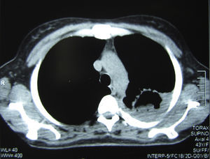 Corte tomográfico de tórax que muestra la cavidad pulmonar con la masa sólida en su interior y el engrosamiento pleural vecino.