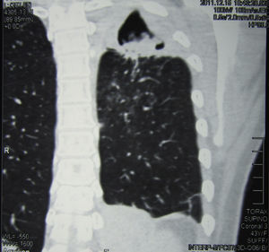 Corte tomográfico de frente donde se observa lo mismo que en la figura 2, en el vértice del pulmón izquierdo.