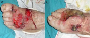 Photograph of the anterior surface of the left (A) and right (B) feet showing ulcerous lesions.