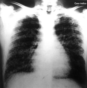 Radiografía de tórax del caso índice. Se observa infiltrado micronodular diseminado con adenopatías en regiones axilares.