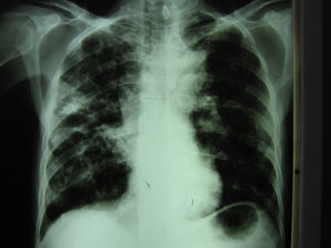 Radiografía de tórax: infiltrados bilaterales intersticioalveolares y cavitados.