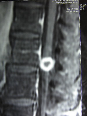 Resonancia magnética nuclear de columna dorsolumbar donde se observa una formación nodular intracanalicular, intradural y extramedular, con realce homogéneo del contrate en anillo que desplazaba las raíces de la cola de caballo.
