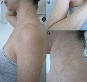 Extensive form of PV in a young woman with (A) mixed, (B) achromic and (C) erythematous patches.