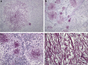 Periodic-acid-Schiff stained sections of Saprochaete capitata infected organs from Patient 4. (a) Histological section of liver showing a colony of S. capitata (original magnification ×40); (b) histological section of spleen showing lymphoid depletion and abundant colonies of S. capitata mimicking “fireworks” (original magnification ×40); (c) histological section of spleen showing lymphoid depletion and abundant colonies of S. capitata (original magnification ×100); (d) large power field of fungal filaments of S. capitata in the spleen, showing occasional branching (original magnification ×400).