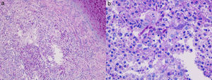 (a) Histological examination showing granulomatous infiltrate with areas of necrosis in the dermis (periodic acid–Schiff stain, 20× original magnification). (b) At greater magnification, the granulomas were seen to be composed of neutrophils, multinucleated giant cells and lymphocytes, with thick-walled septate structures identified as fungal elements (periodic acid–Schiff stain, 40× original magnification).