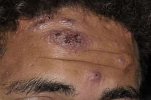 Paracoccidioidomycosis: papule, nodule, infiltrated and ulcerative lesion on frontal region.