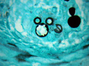 Paracoccidioidomycosis: typical aspect of P. brasiliensis on the dermis (silver methenamine ×1000).