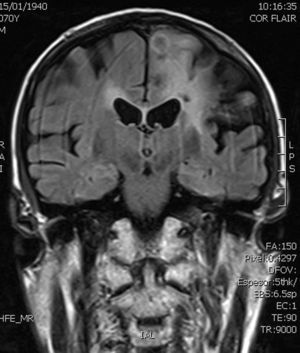 Resonancia magnética cerebral que muestra una lesión intraparenquimatosa corticosubcortical en región parietal izquierda.