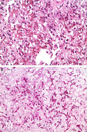 Histopatología de la biopsia cerebral. Se aprecian abundantes conidios ovales junto con hifas tabicadas sobre tejido necrótico. A) Tinción de hematoxilina-eosina (x400). B) Tinción de ácido peryódico de Schiff –PAS– (×400).