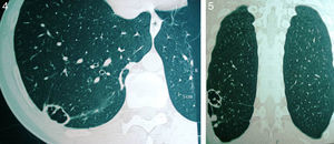 Imágenes de la tomografía computarizada de tórax después del tratamiento. Obsérvense las secuelas cavitarias.