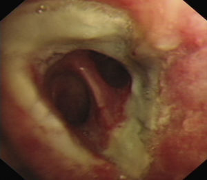 Infección aspergilar de la sutura bronquial. Traqueobronquitis por Aspergillus fumigatus.