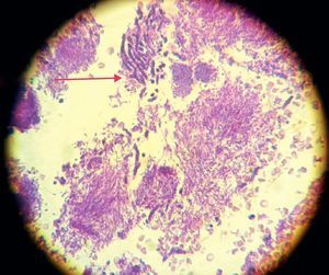 Levaduras y seudomicelios presentes en el biofilm subgingival de un paciente con periodontitis grave (corte de tejido gingival, tinción con hematoxilina-eosina, 40X). La flecha señala seudomicelios de Candida.