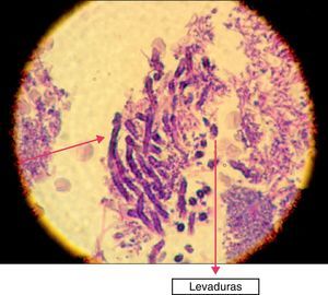 Levaduras y seudomicelios en el tejido gingival de un paciente con periodontitis grave (tinción PAS, 100X). Las flechas señalan seudomicelios y levaduras de Candida en un biofilm bacteriano PAS positivo.