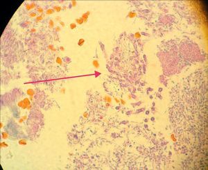 Observación de levaduras y seudomicelios (flecha) de Candida presentes en el biofilm subgingival de un paciente con periodontitis grave (corte de tejido gingival con tinción tricrómica, 40X).